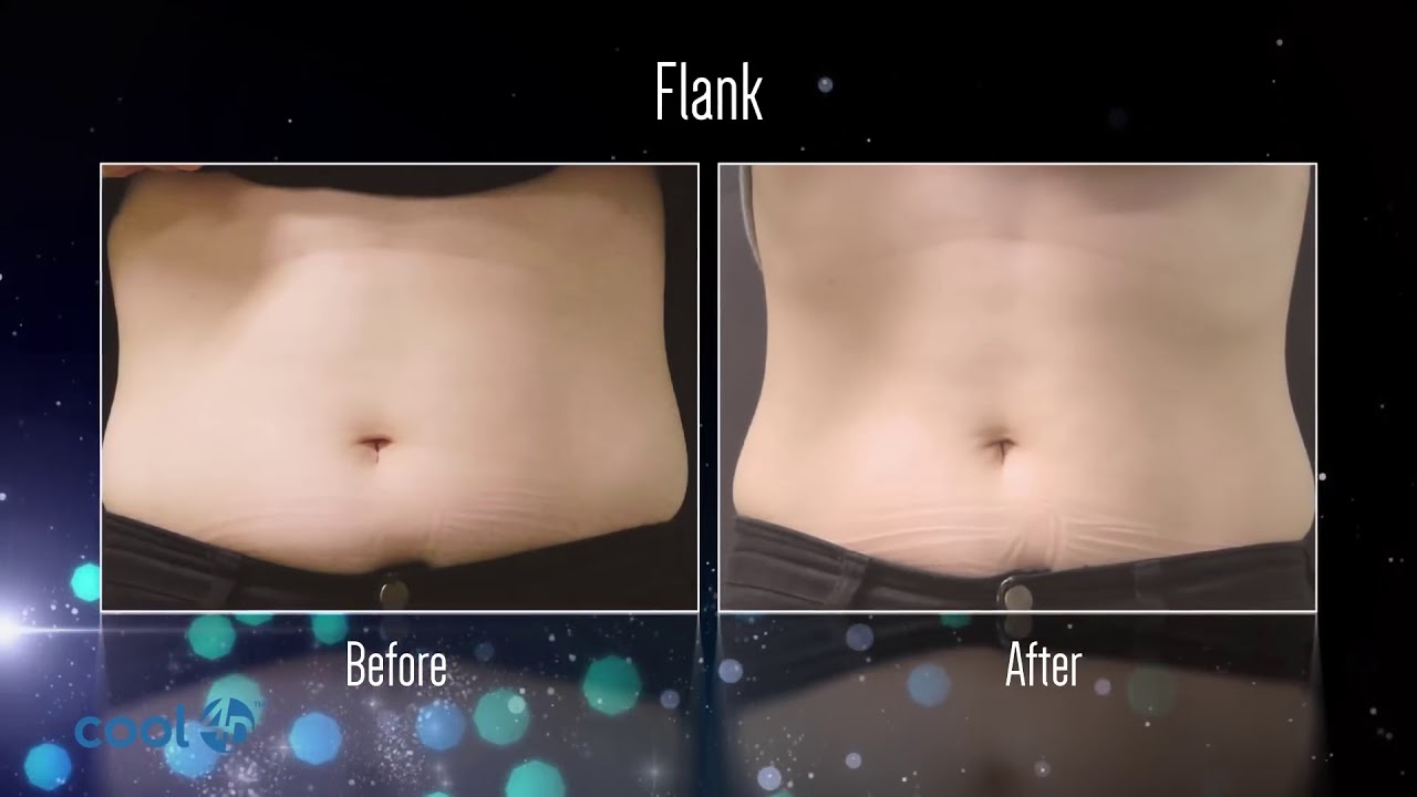 Cluederm Cool 4D Fat Freezing Technology  Affordable Yet Powerful Portable Table-Top Device