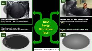 2026 IOTA two step strategy to classify Ovarian Masses
