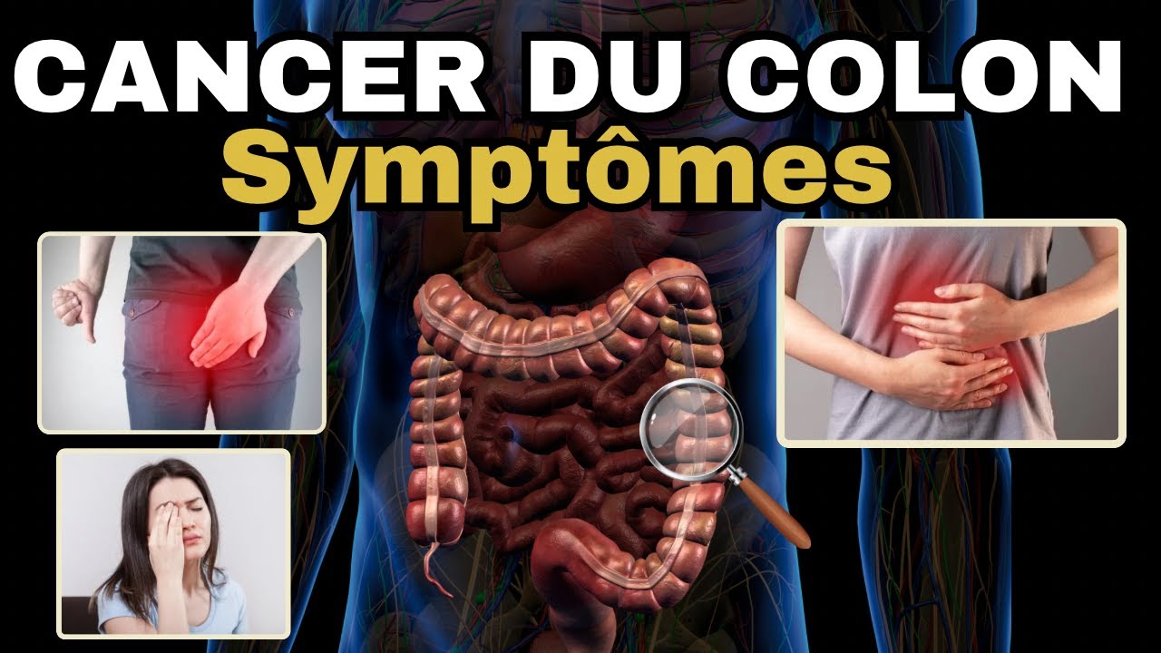 SYMPTMES les plus frquents du CANCER DU COLON cancer colorectal
