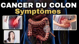 SYMPTÔMES les plus fréquents du CANCER DU COLON (cancer colorectal)