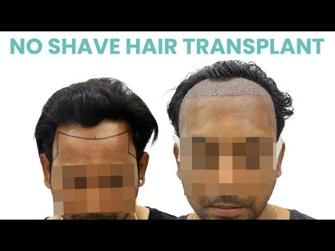 No Shave Hair Transplant | Celebrity Hair Transplant |