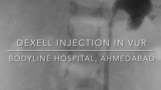 Dexell Injection In 8 Year Old Female With Grade Iii Vur