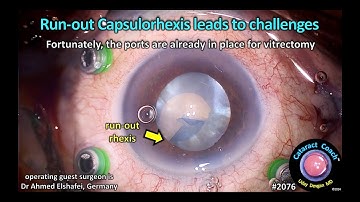 CataractCoach™ 2076: run-out capsulorhexis leads to challenges