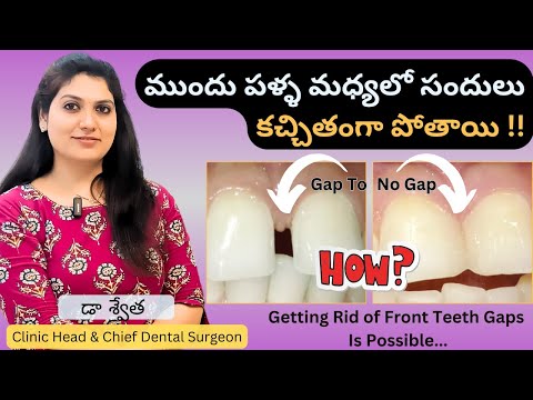 3 Best Teeth Gap Treatment | Diastema | Gap Teeth Filling | Palla Sandulu in Telugu | Dr Swetha