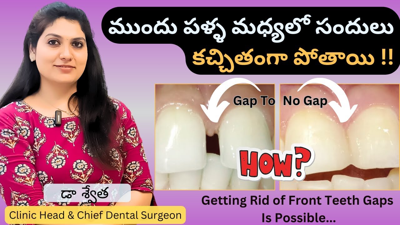 3 Best Teeth Gap Treatment Diastema Gap Teeth Filling Palla Sandulu in Telugu Dr Swetha