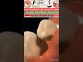 Know this about Wisdom Tooth #wisdomtooth #dentist #teeth