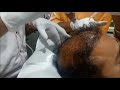 Prp procedure for hair loss problem by dr ashutosh shah at elegance clinic surat gujarat
