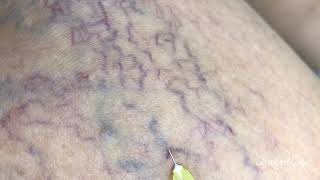 Micro sclerotherapy for spider veins