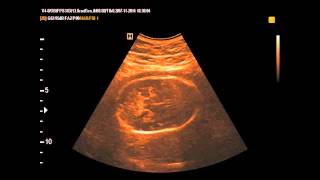 Med2000Eco Dolicocefalia