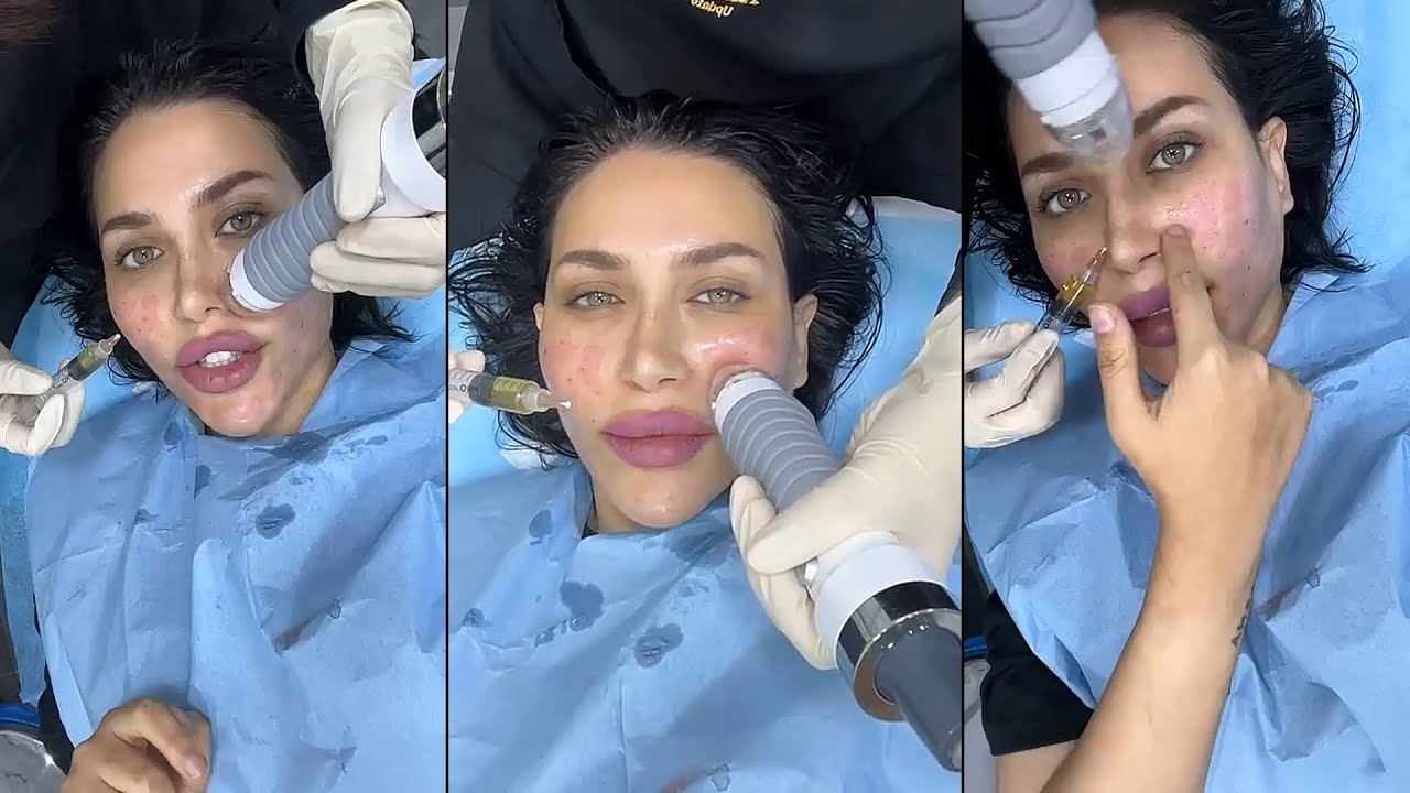 دكتوره خلود تسوي جلسة فيفاتشي للمره العاشره بعد تحسن بشرتها بشكل كبير 💙