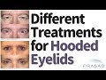 Different Procedures for Treating Hooded Eyelids and Heavy Brows
