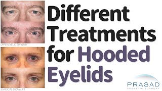 Different Procedures for Treating Hooded Eyelids and Heavy Brows