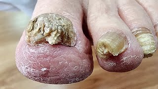 PEDICURE TRANSFORMATION. Cleaning and cutting toenail.