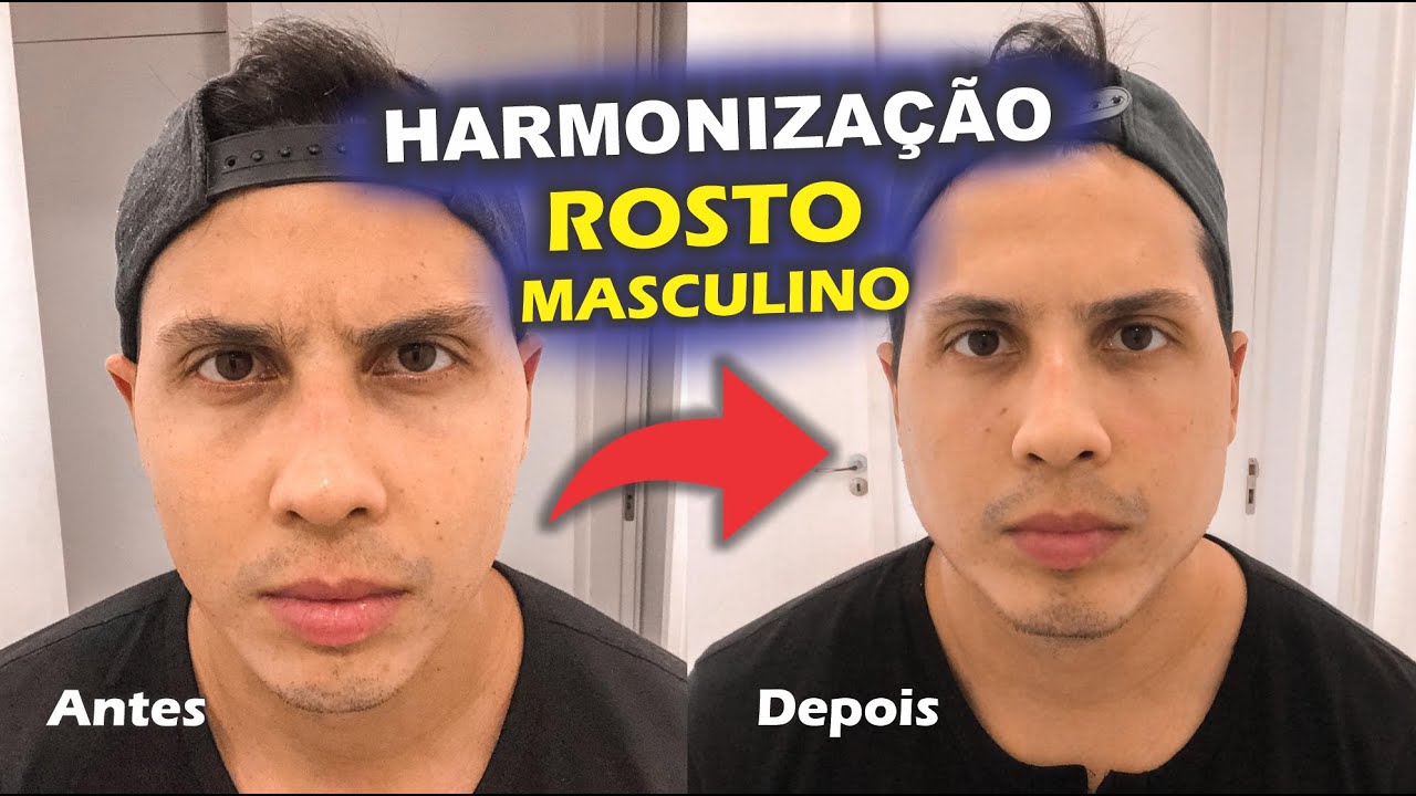 HARMONIZAÇÃO FACIAL (Antes e depois) mandíbula, nariz, queixo e olheiras  (Falei quanto custa) 