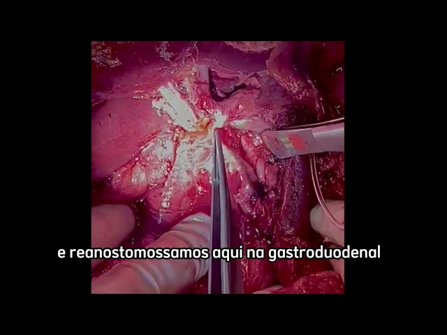 Revascularização Arterial Hepática após Gastroduodenopancreatectomia