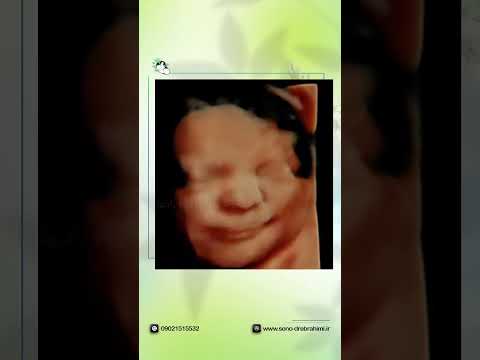 خنده و گریه ی جنین تصویر چهاربعدی جنین