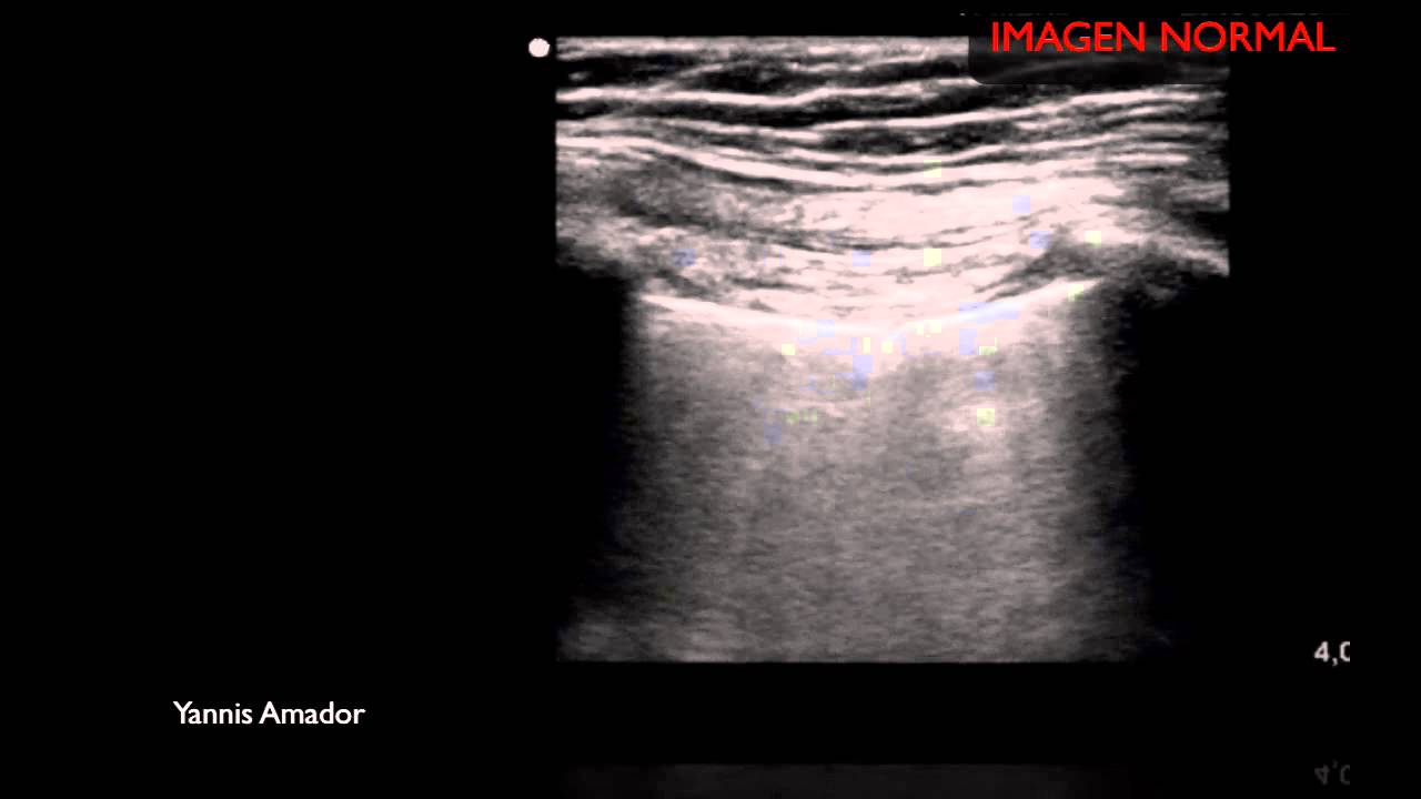 ECO PULMONAR EN NEUMOTORAX - YouTube