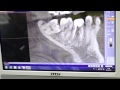 Удаления 8-го зуба (зуба мудрости). Диагностика с помощью КТ.