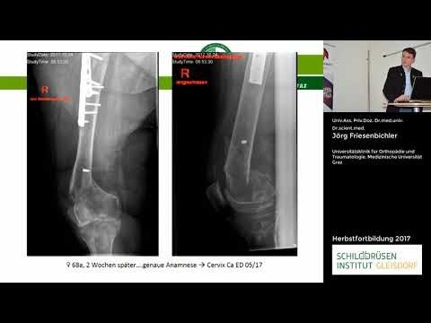 Video: Indirekte Estimering Af Prævalensen Af spinal Muskelatrofi Type I, II Og III I USA