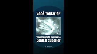Tracionamento De Incisivo Central Incluso