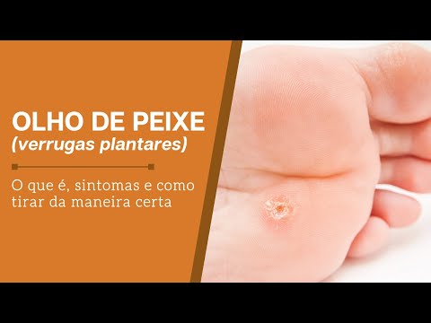 Vídeo: 7 maneiras de se livrar de uma verruga na planta do pé