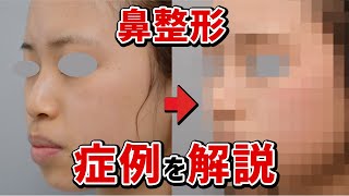 【鼻整形】症例写真で解説！！鼻中隔延長＋鼻尖形成術＋鼻プロテーゼ@logicbeautyclinic