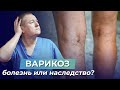 ВАРИКОЗНОЕ РАСШИРЕНИЕ ВЕН