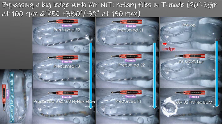 An easy technique to bypass a big ledge with T-mode/Tモードを用いた大きなレッジのバイパス形成法