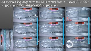 An easy technique to bypass a big ledge with T-mode/Tモードを用いた大きなレッジのバイパス形成法