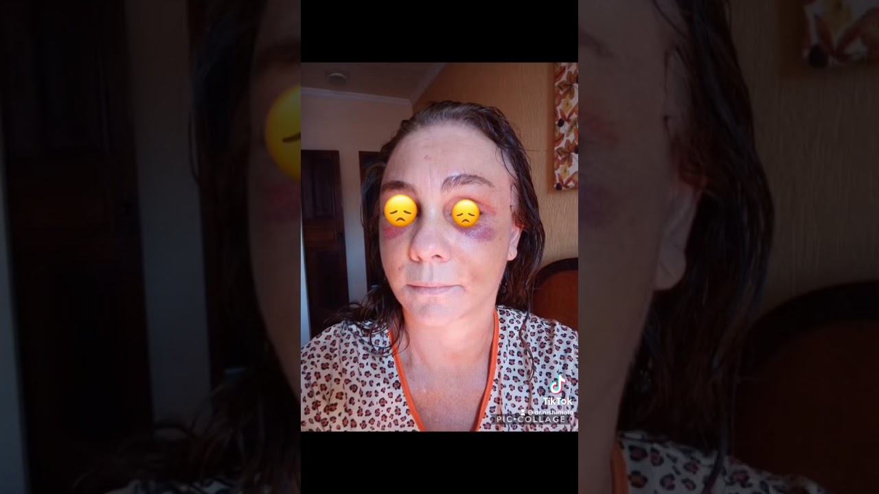 Evolução do lifting facial !