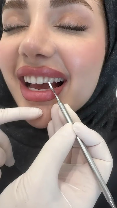 Estetik bonng dolgu #laminediş #zirkonyumkaplama #ciltbakımı #dentalclinic