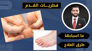 بث صيدلاني / فطريات القدم (القدم الرياضي) علاجها واسبابها واحدث اخبار الصحة