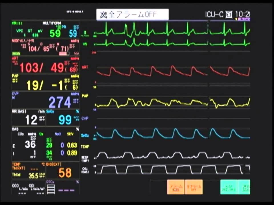 麻酔中のモニター 循環モニター