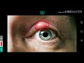 CHALAZION