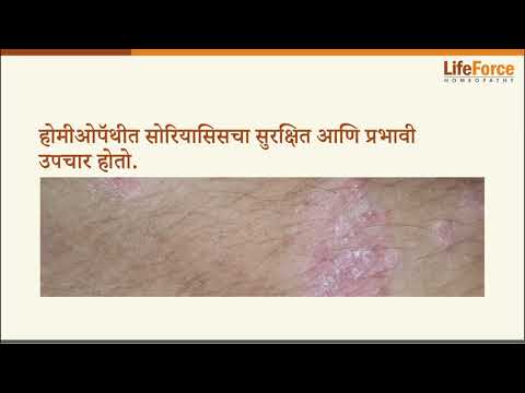What should you know about Psoriasis treatment Marathi- Part 4/5