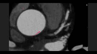 Severe stenosis mid LAD (CT Coronary and Coronary Angiogram) screenshot 5