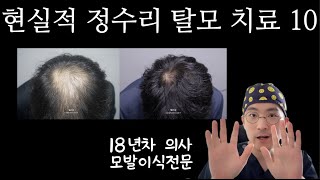 탈모엔 털슨상:) 현실적 정수리 치료 10가지