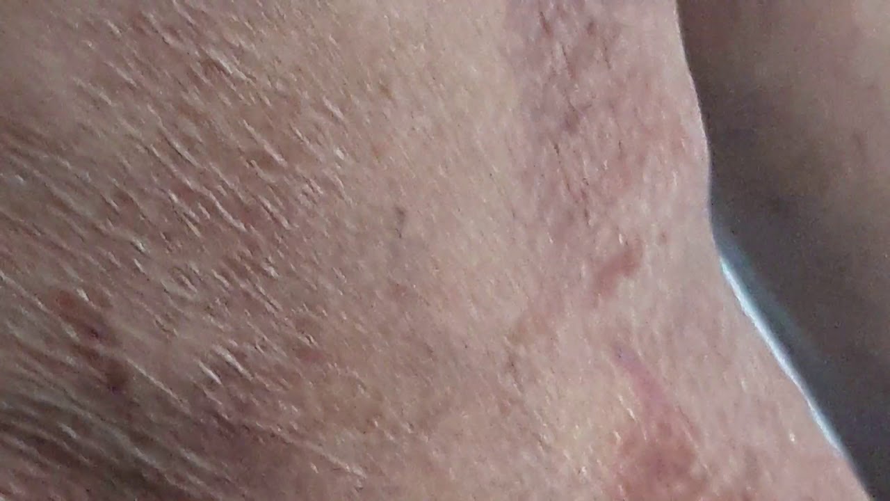 Eczema body+Ecchymosis arms YouTube