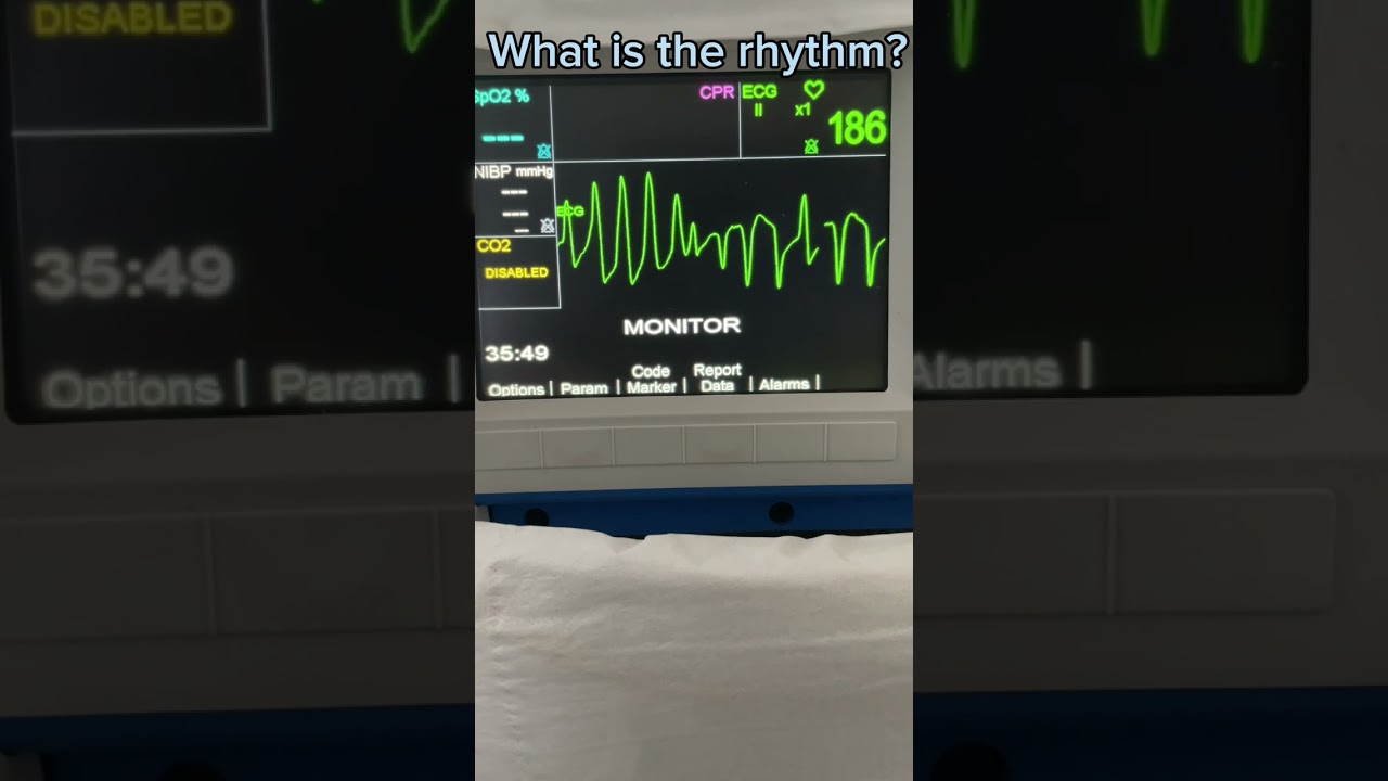 What is the rhythm? EP.11 