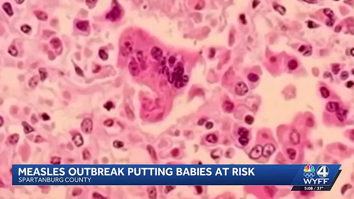 Upstate measles outbreak putting babies at risk