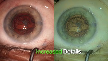 Ngenuity 3D custom digital filter enhancement for anterior segment surgery