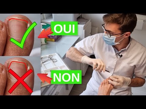 Vidéo: 3 façons d'utiliser les coupe-ongles