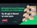 Spondylolisthesis           journey of resilience and hope
