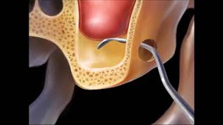 Sinus Lift, Podniesienie Dna Zatoki Szczękowej