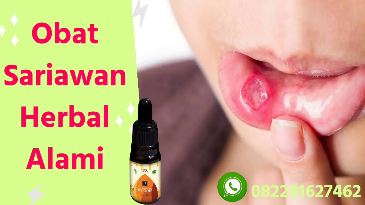 OBAT SARIAWAN HERBAL WA 082281627462 