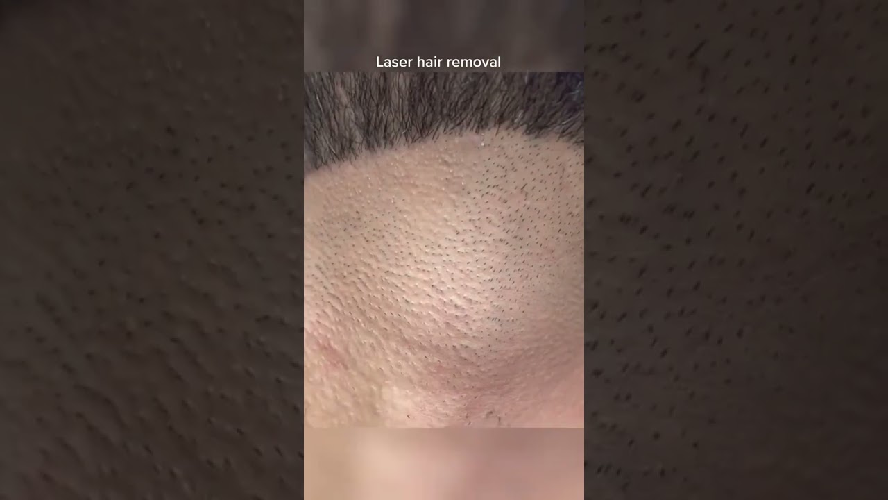 Can you use laser hair removal on your beard? mens laser hair removal