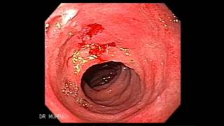 Endoscopia de Enfermedad Celíaca