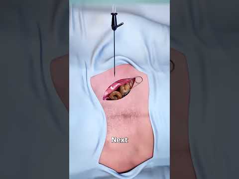 How Embalming A Body Works 