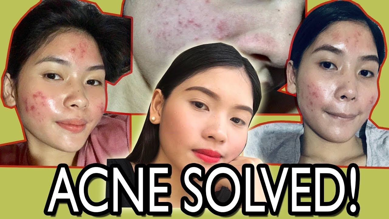 MY ACNE STORY 2019 | HOW I SOLVE MY ACNE PROBLEM | (MUST WATCH TILL END ...