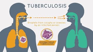 Tuberculosis: A Global Health Challenge